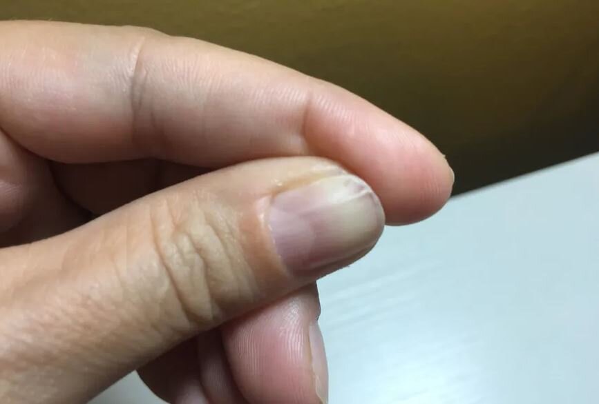 تولید داروی پلیمری دقیق برای درمان یک نوع قارچ ناخن